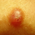 HISTIOCYTOMA - WŁÓKNIAKI TWARDE (DERMATOFIBROMA)