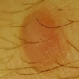 HISTIOCYTOMA - WŁÓKNIAKI TWARDE (DERMATOFIBROMA)