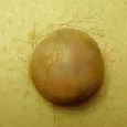 HISTIOCYTOMA - WŁÓKNIAKI TWARDE (DERMATOFIBROMA)