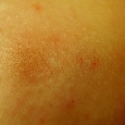 HISTIOCYTOMA - WŁÓKNIAKI TWARDE (DERMATOFIBROMA)