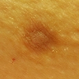 HISTIOCYTOMA - WŁÓKNIAKI TWARDE (DERMATOFIBROMA)